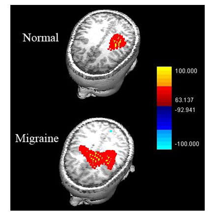 MEG results combined with MR images: normal versus migraine.